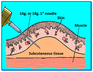 G2159-3 Subcutaneous Injection